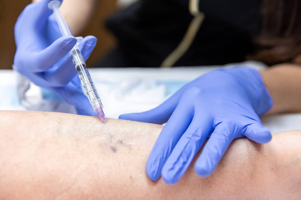 Cosmetic Sclerotherapy