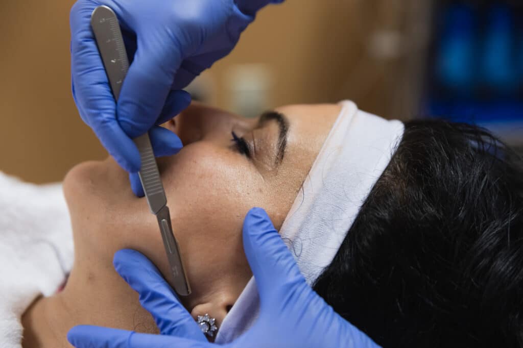 Dermaplaning