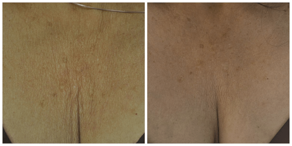 Exilis skin tightening - Before and After