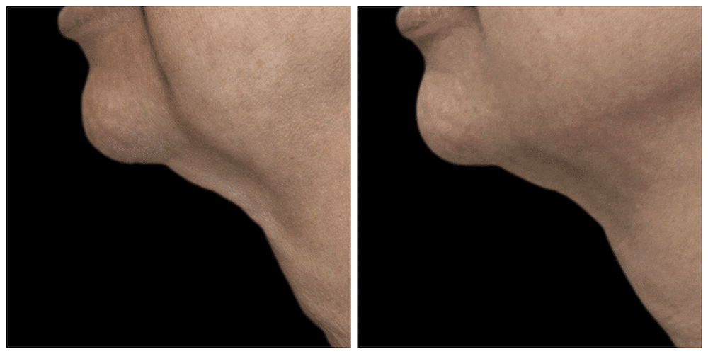Neck Skin Tightening - Before and After