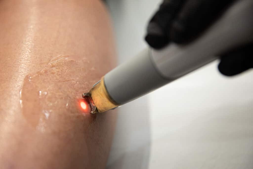 Laser Vein Removal