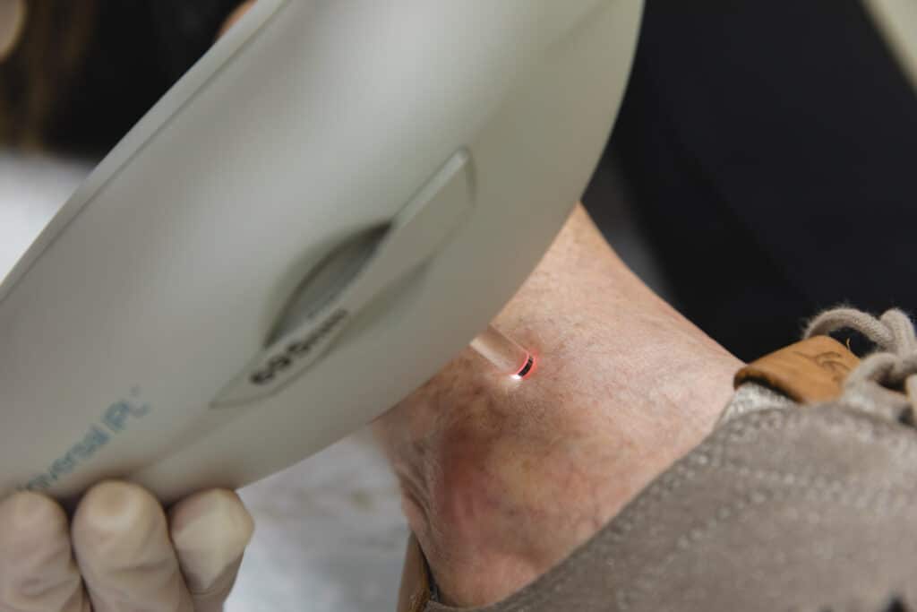 Laser Vein Removal