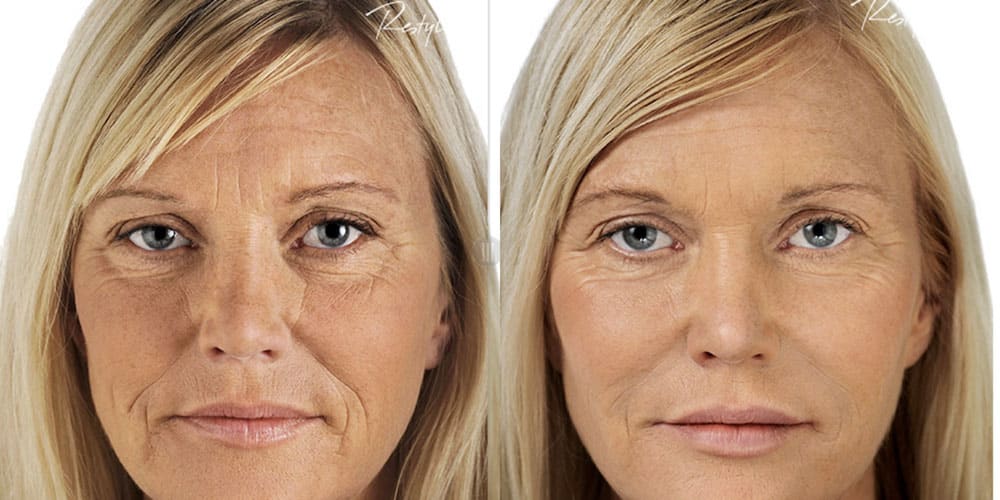 RHA before and after face rejuvenation
