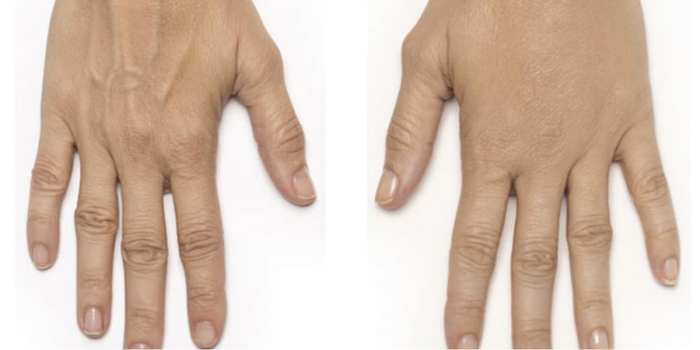 Radiesse before and after hand rejuvenation