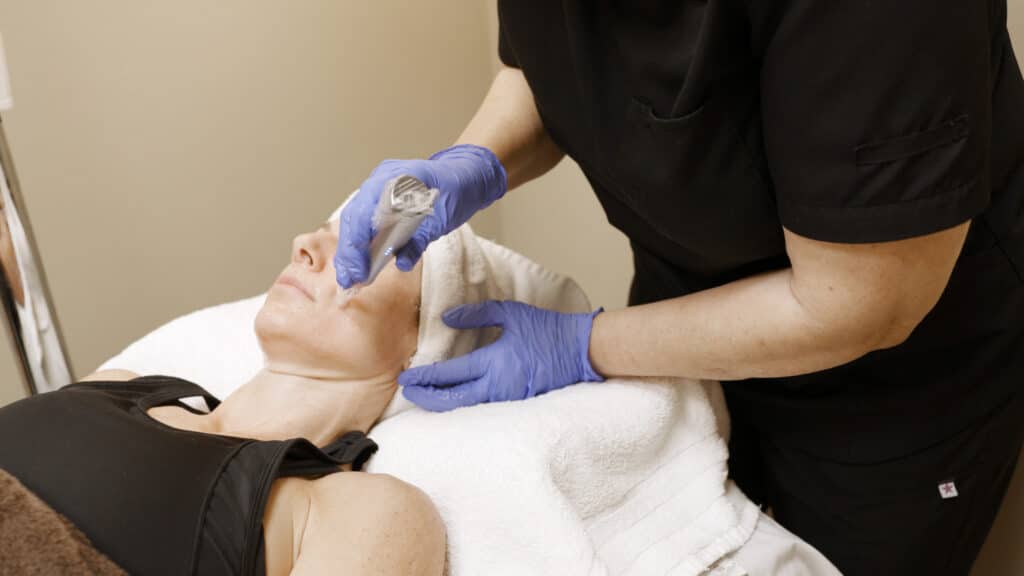 Renaissance Dermatology PRP Microneedling