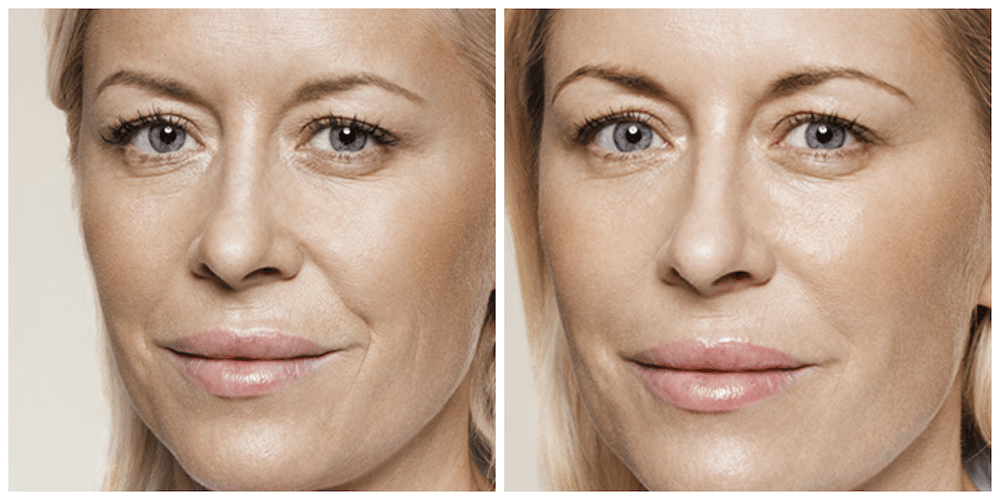 Restylane before and after face Rejuvenation