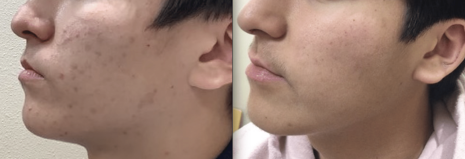 Acne therapy before and after