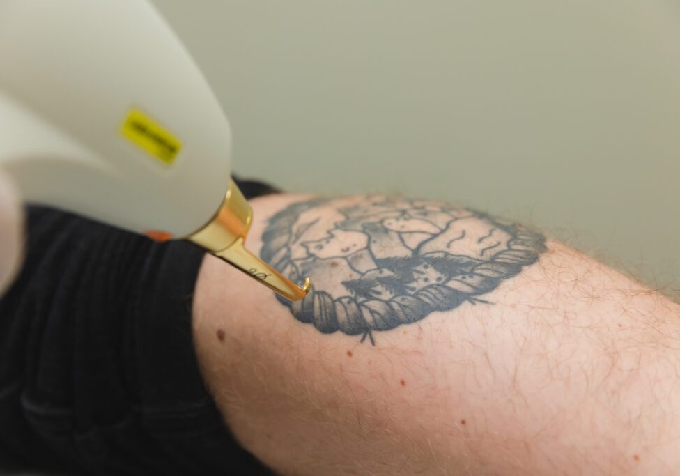 Laser Tattoo Removal