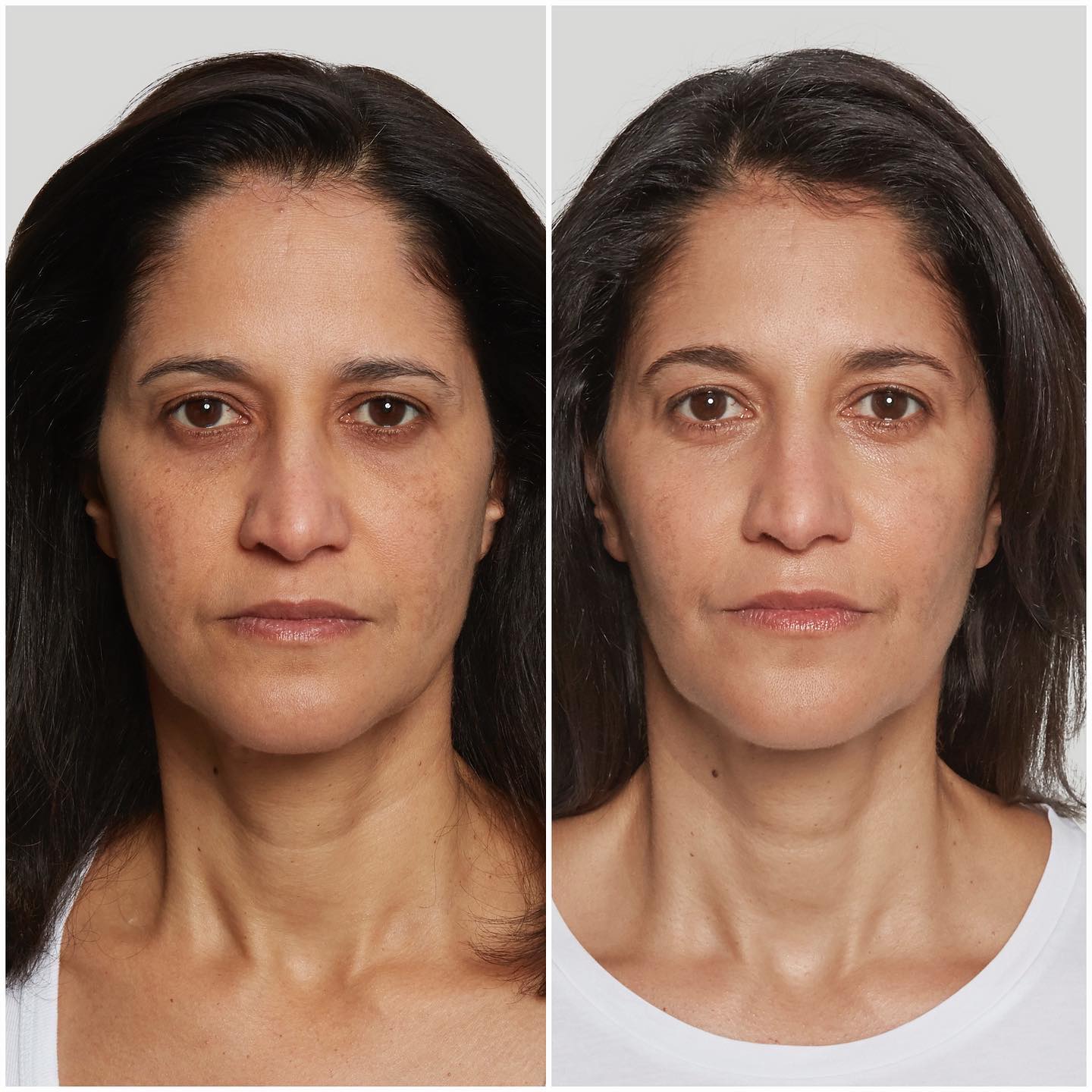 Sculptra - Before and After