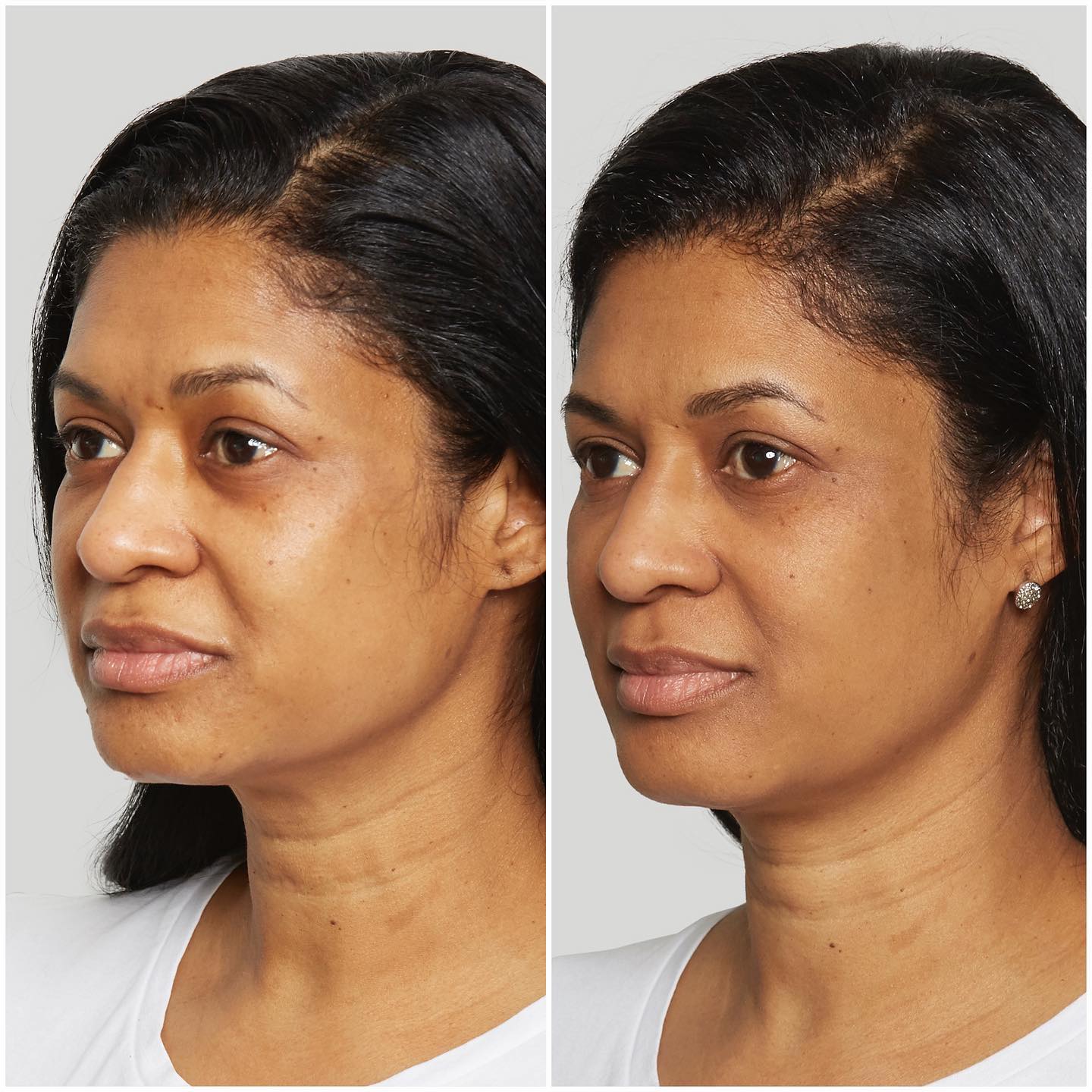 Sculptra - Before and After