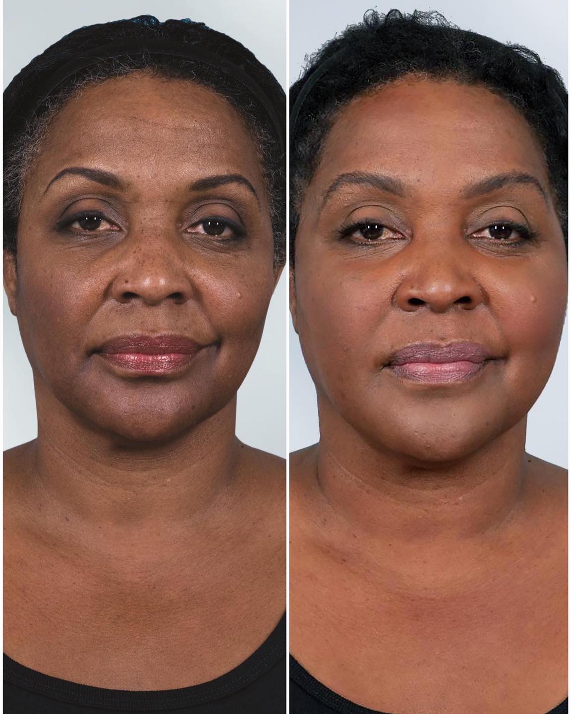 Sculptra - Before and After