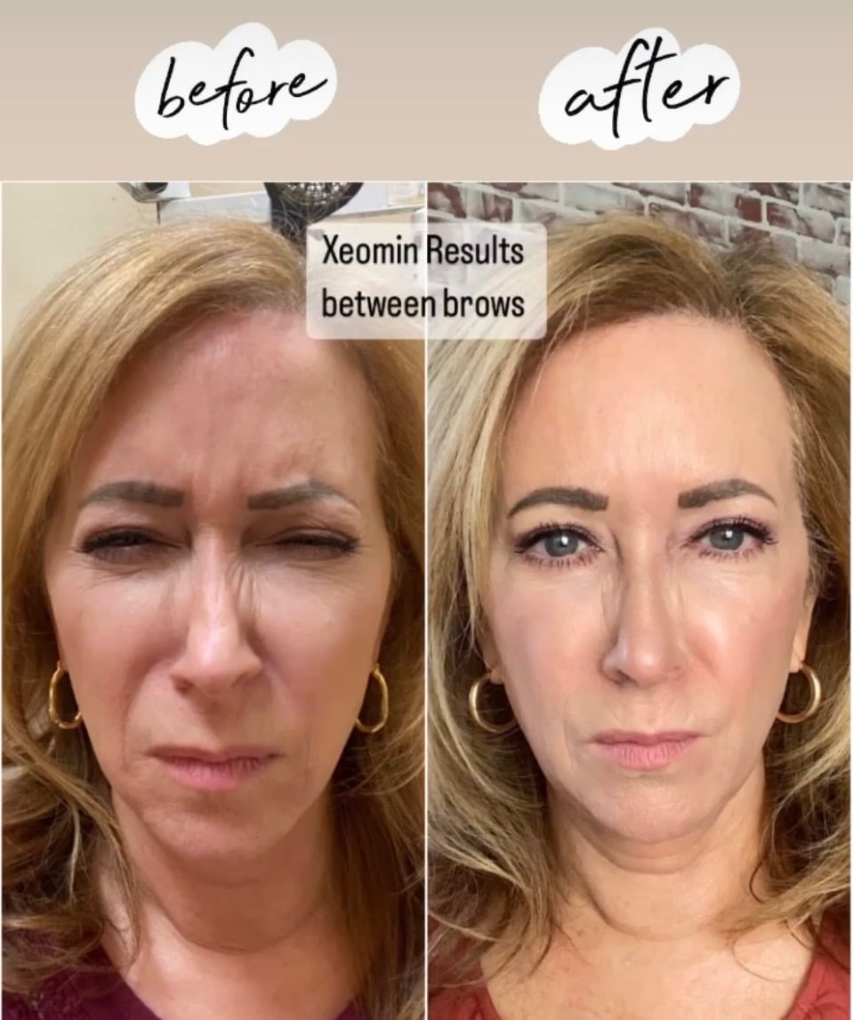 Xemoin - Before and After